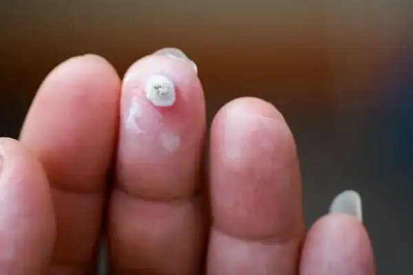 Image of white wart before cryopen treatment Coatbridge