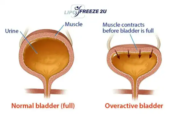 diagram of overactive bladder treatment Coatbridge