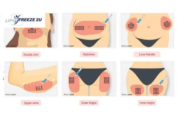 Benefits of Choosing Aqualyx for Fat Reduction Coatbridge