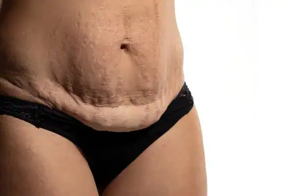 loose skin after weight loss injections Coatbridge