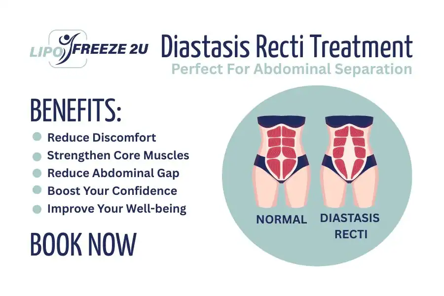 Benefits of body toning treatment Coatbridge for Diastasis recti