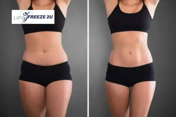 How Can LIPO FREEZE 2U Support Your Post-Pregnancy Body Recovery Coatbridge?