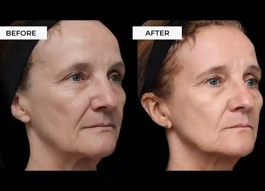 How Many RF Microneedling Sessions Will You Need to See a Difference Coatbridge?