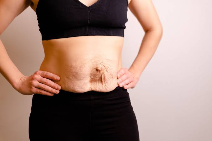 Is Surgery Really the Only Way to Repair Diastasis Recti Coatbridge?