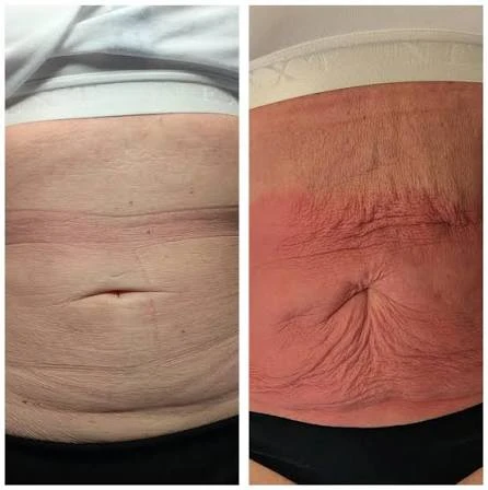 How Does RF Microneedling Improve Crepey, Thin and Uneven Skin Texture Coatbridge?