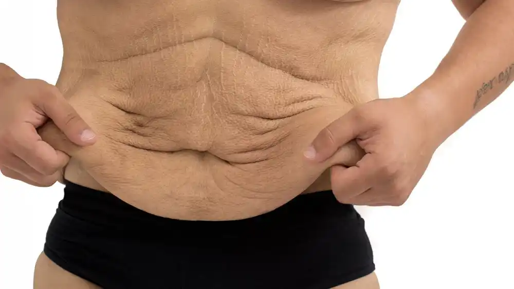 Why Does Weight Loss Medication Leave Some People With Loose or Sagging Skin Coatbridge?